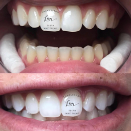 30 Minute Teeth Whitening