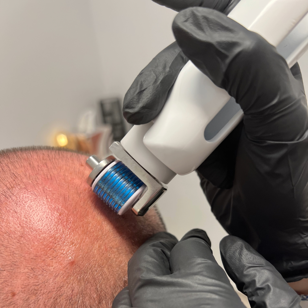 Čistenie pokožky hlavy s aplikáciou séra NEOHAIR mikroihličkami