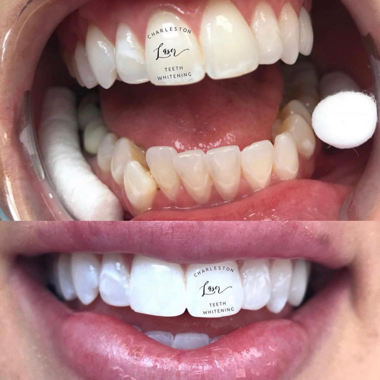 1 Hour Teeth Whitening Chair B