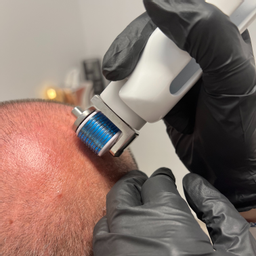 Čistenie pokožky hlavy s aplikáciou séra NEOHAIR mikroihličkami