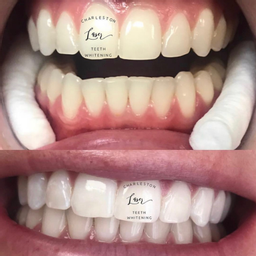 1 Hour Teeth Whitening Chair A