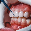 Blanchiment Dentaire Nantes