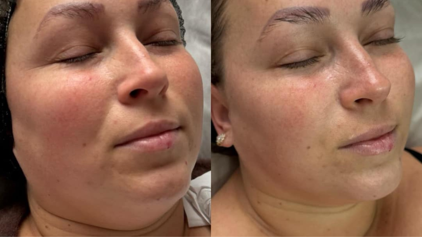 Wonderland Hifu, Carbon peeling, ultrafift