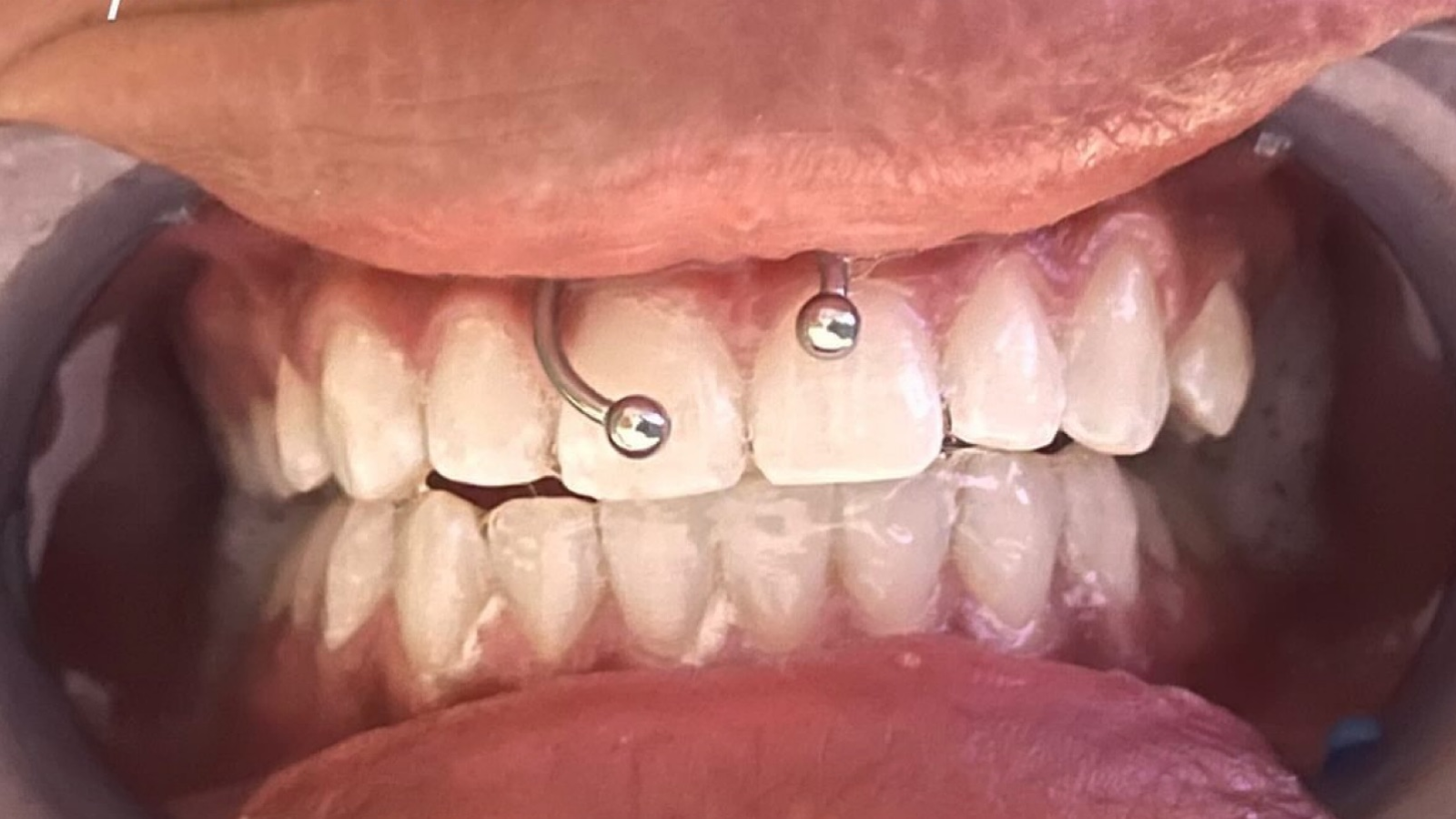 Blanchiment Dentaire Nantes