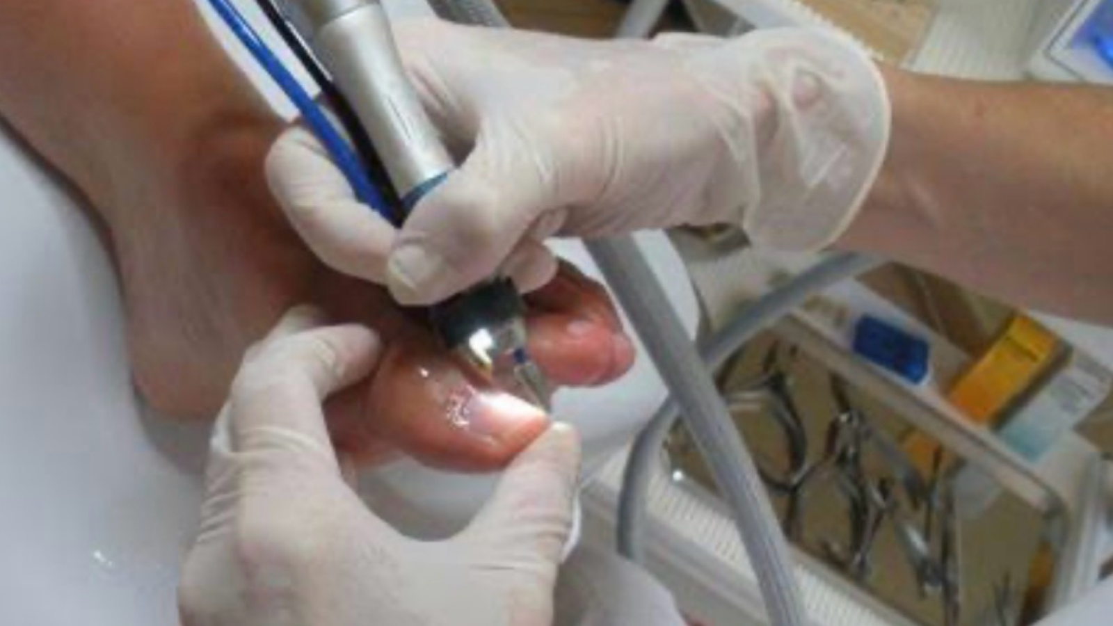 Medische pedicure Zerdacare