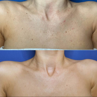 IPL odstranění pigmentace dekolt