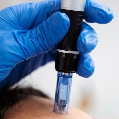 Mikrojehličkování -microneedling 60min