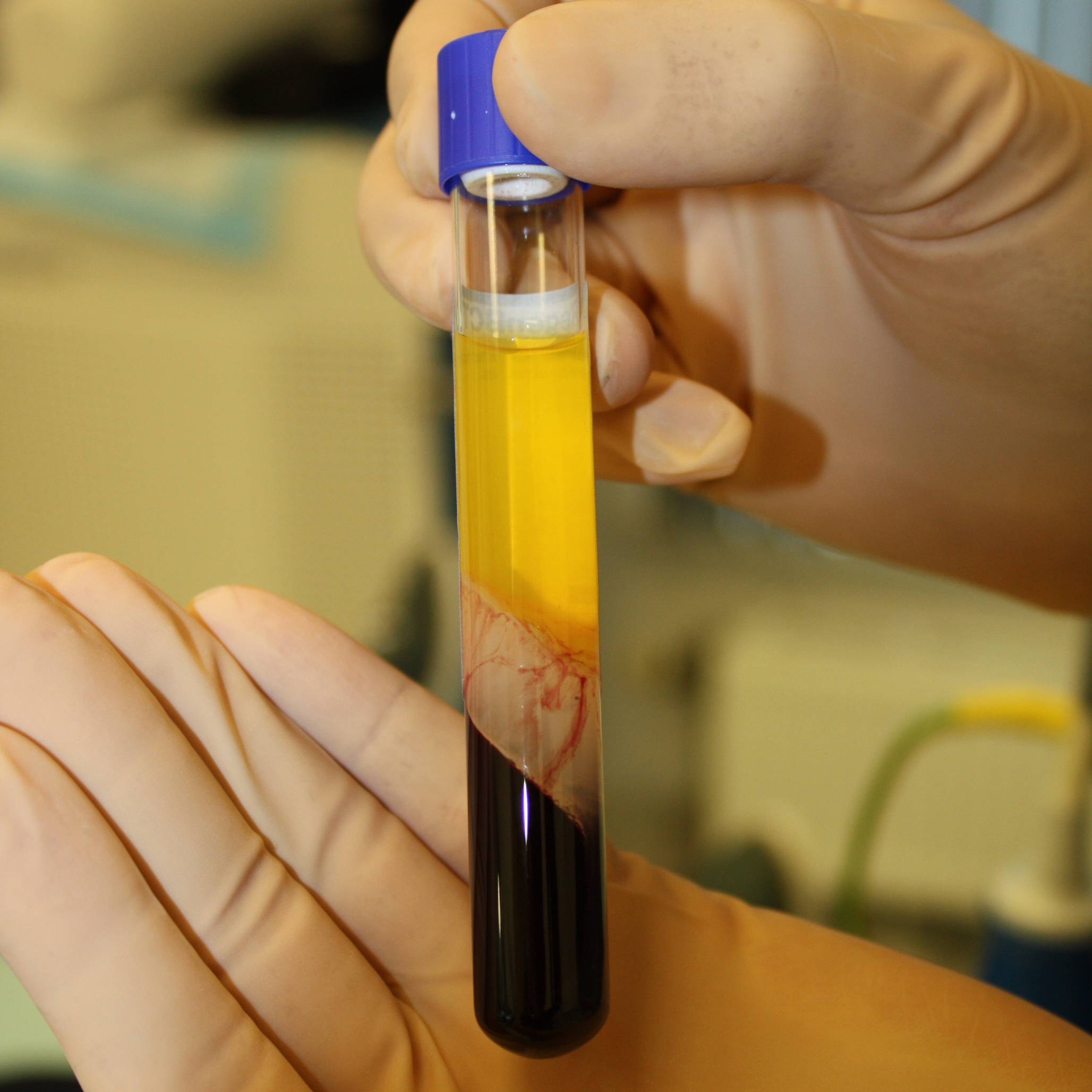 5 PRP haar-behandelingen