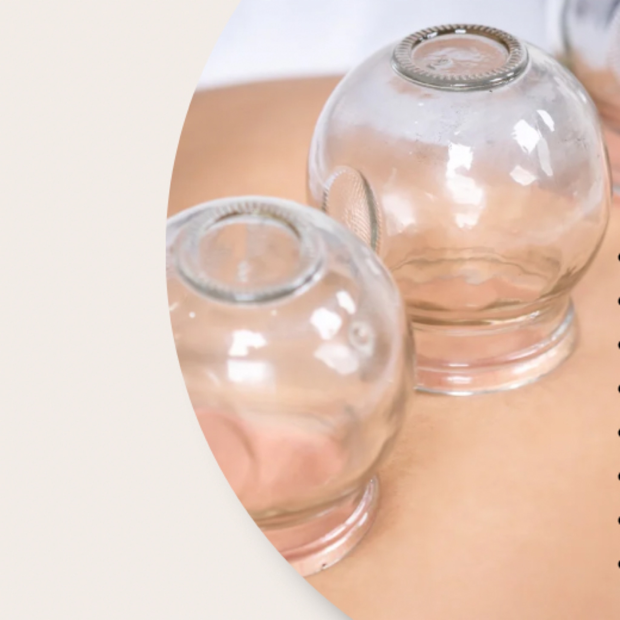 Horké baňkování (rychlá pomoc)