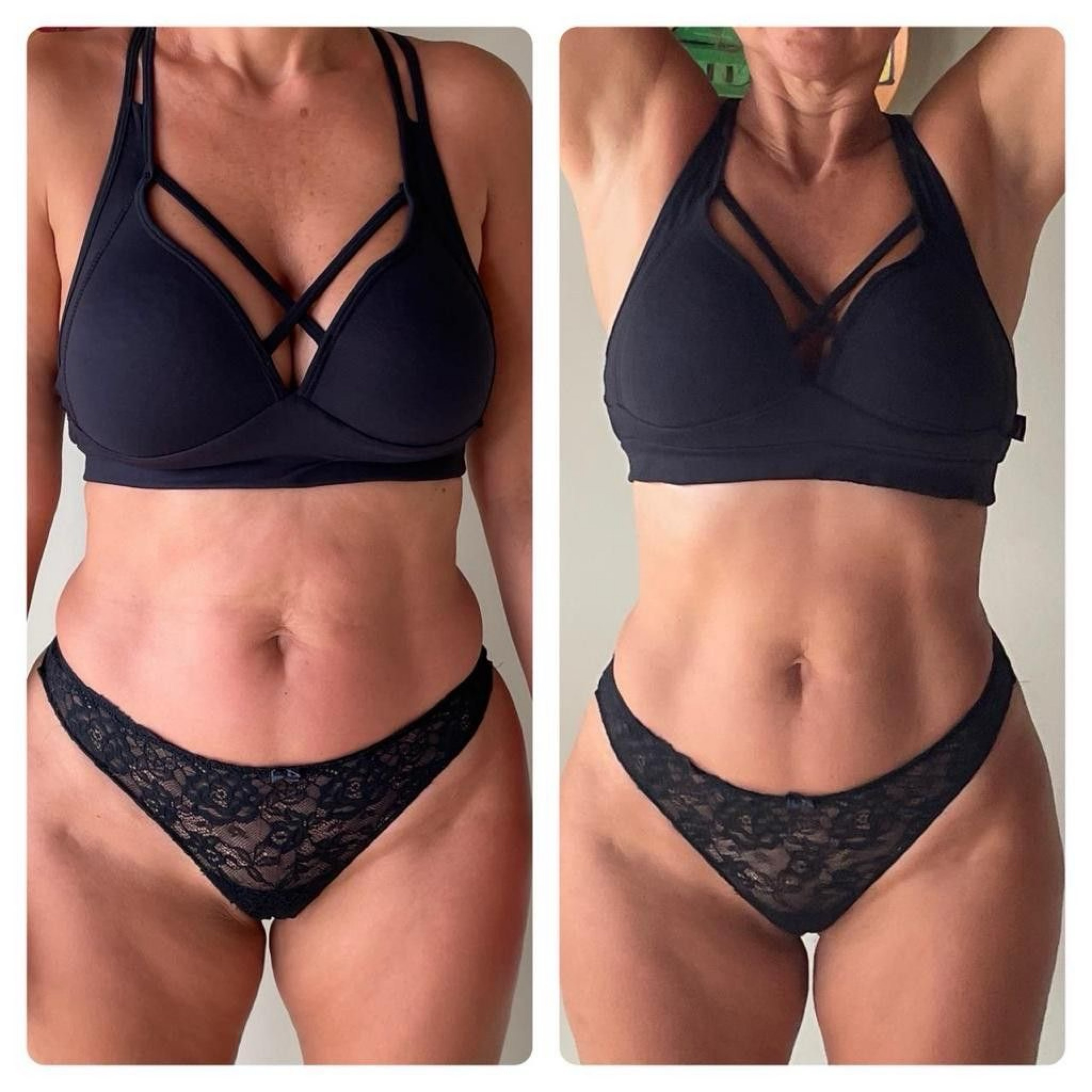 Mesolipo Terapie+VelaShape Liposukce - Břicho