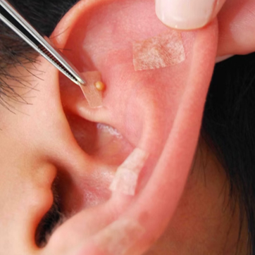 Ariculoterapia (Pacote 2 Sessões)