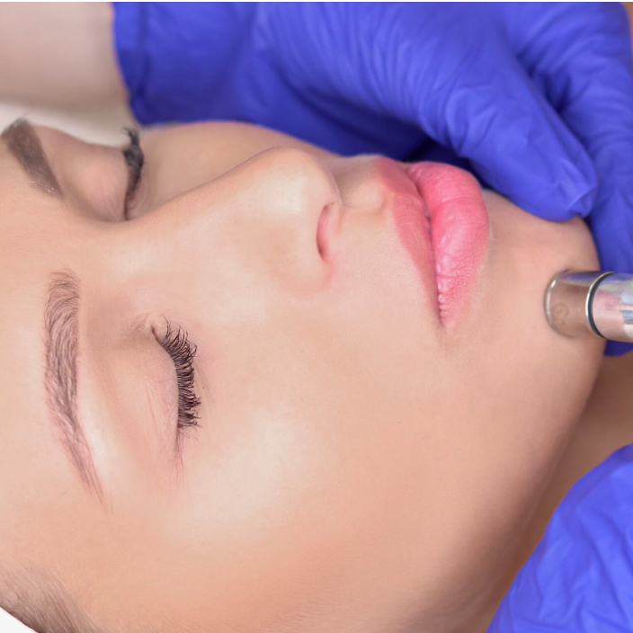 Diamantová mikrodermabrázia + mezoterapia non invaziv