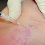 ESCLEROTERAPIA (REMOÇÃO DE VASINHOS )
