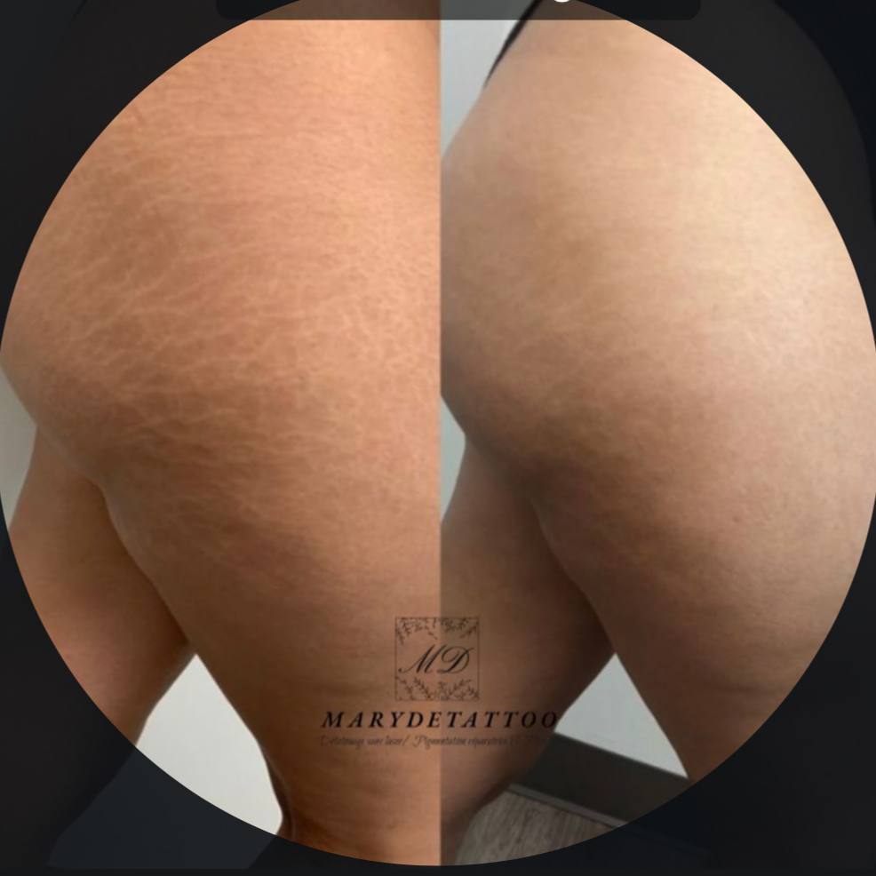 Traitement des vergetures/cicatrices