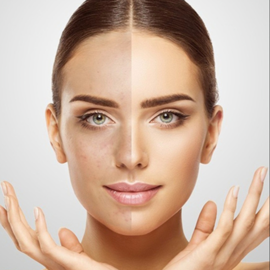 Lifting PEPTIDE mit SNAP-8 TM , Hyaluronsäure 4D und Ultraschall