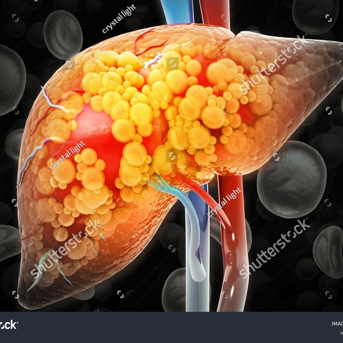 DIETA COLESTEROL - HIGADO GRASO