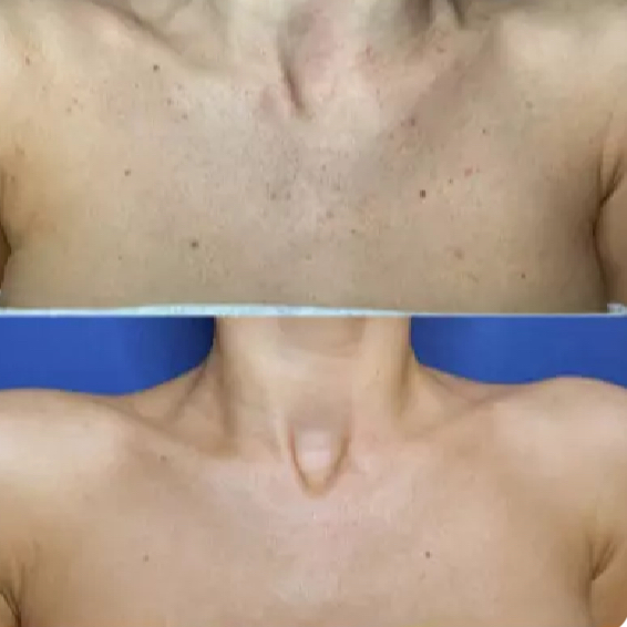 IPL odstranění pigmentace dekolt