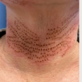 Plasma pen - vrásky na krku