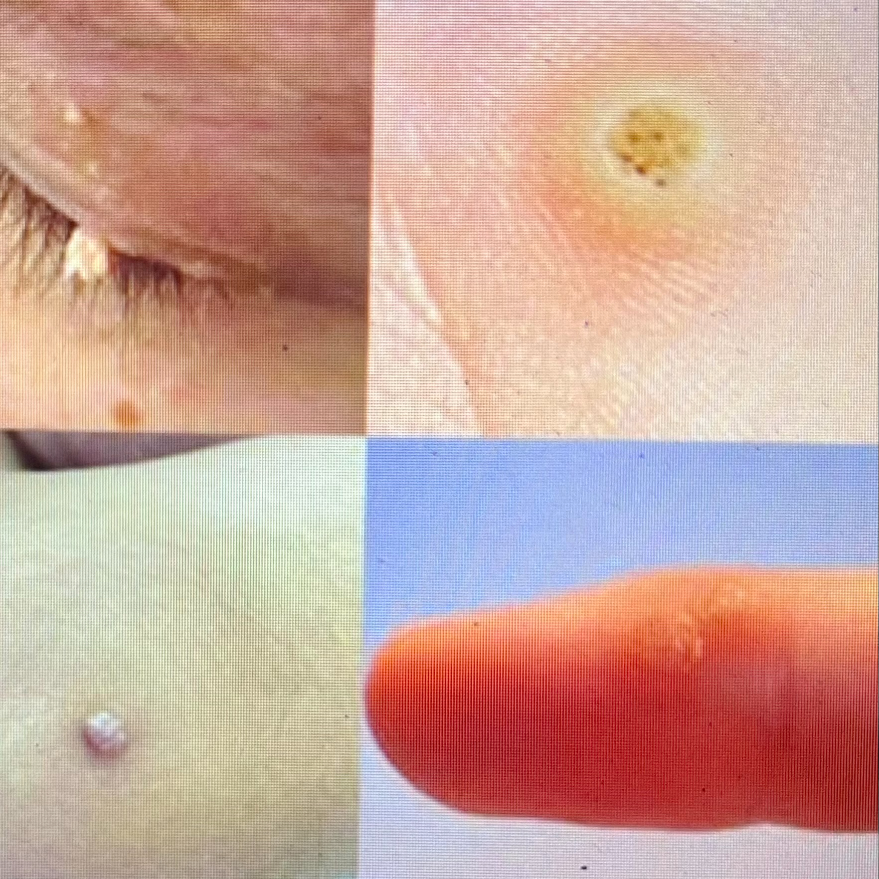 Eliminar verrugas con laser