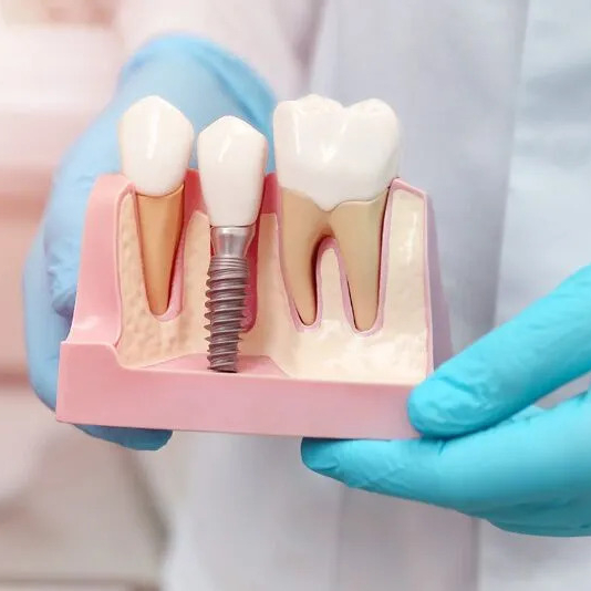 Dental Implants Near Me