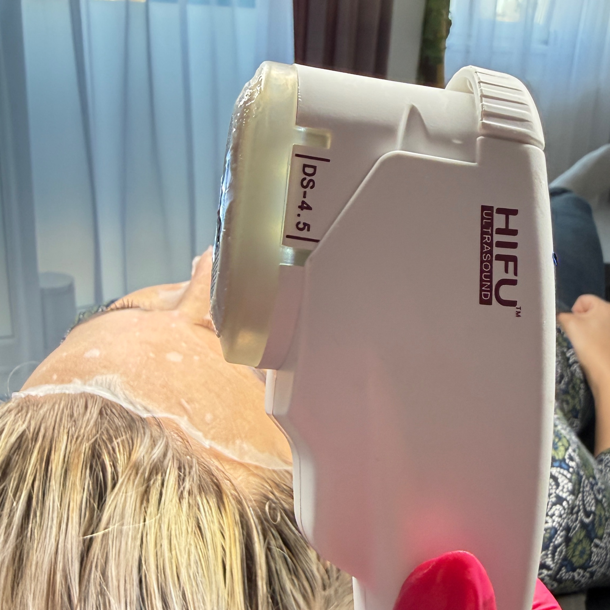 HIFU - Ultralift (očné okolie a oči )