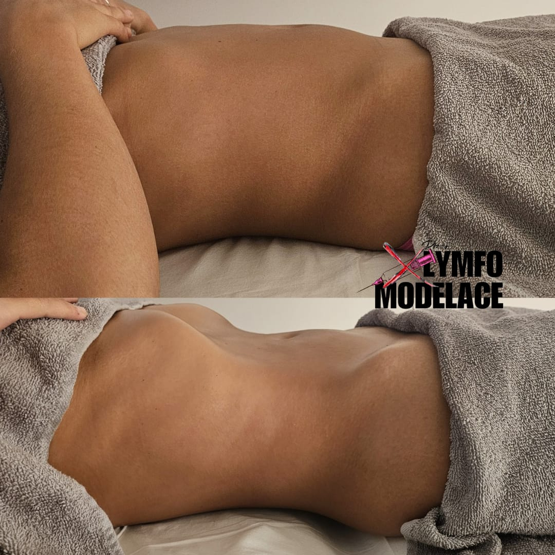 LYMFOMODELACE - LinfoModellante®