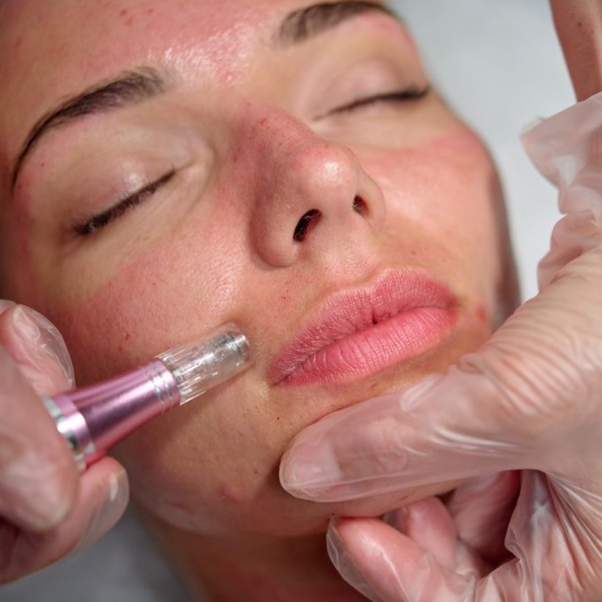 Sejtmegújító Microneedling kezelés LED fényterápiával