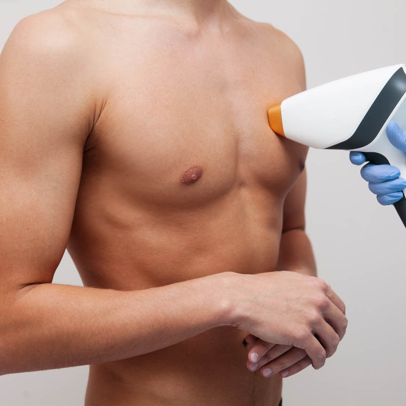 Depilação Laser SHR Tórax+Abdómen+Axilas (Homem)