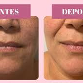 PREENCHIMENTO DE SULGO NASOGENIANO (BIGODE CHINÊS)