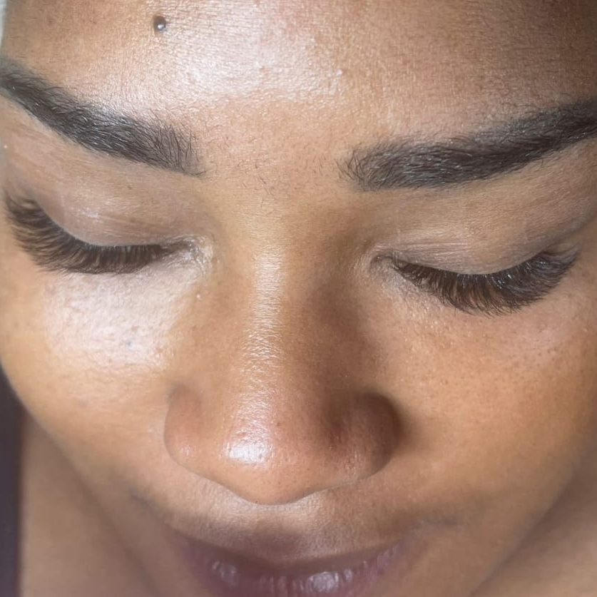 Opvullen volume tot 3 weken