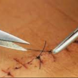 Rimozione Punti Sutura