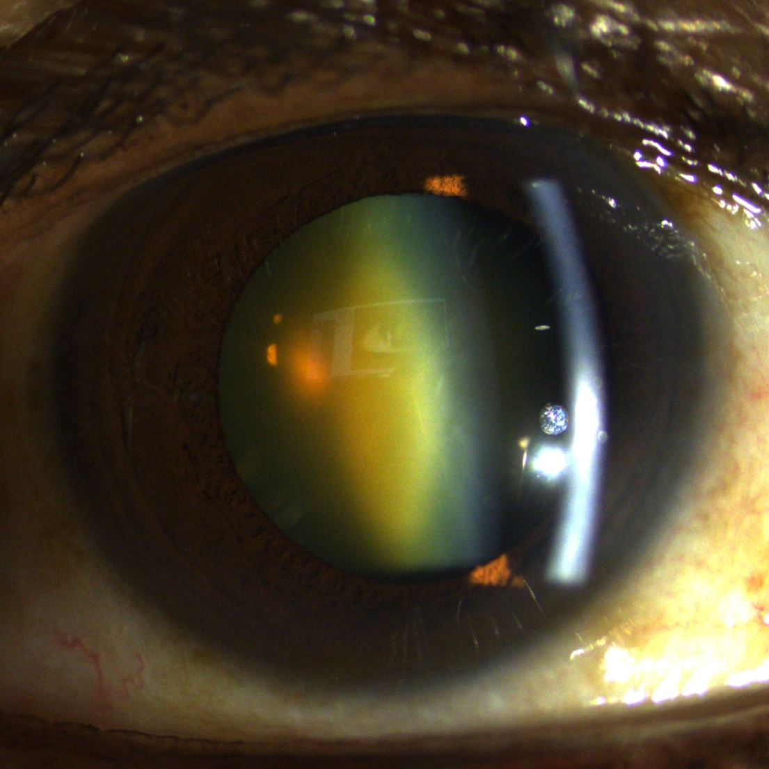 Consultation at The Eye Clinic - CATARACT