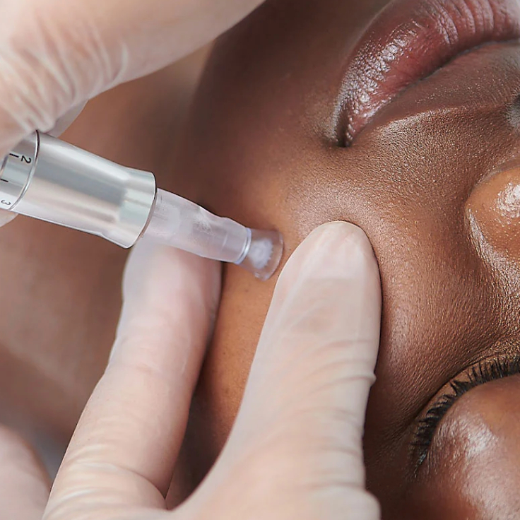 Nano Needling (30 mins)