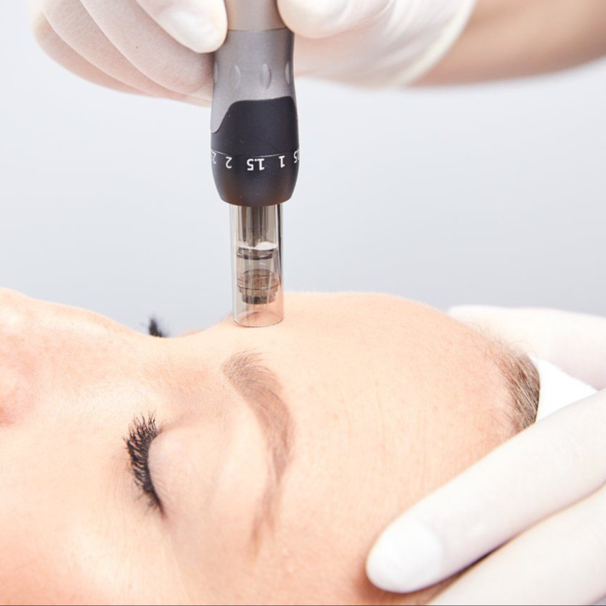 Mikrojehličkování, (obličej,krk) 70min.