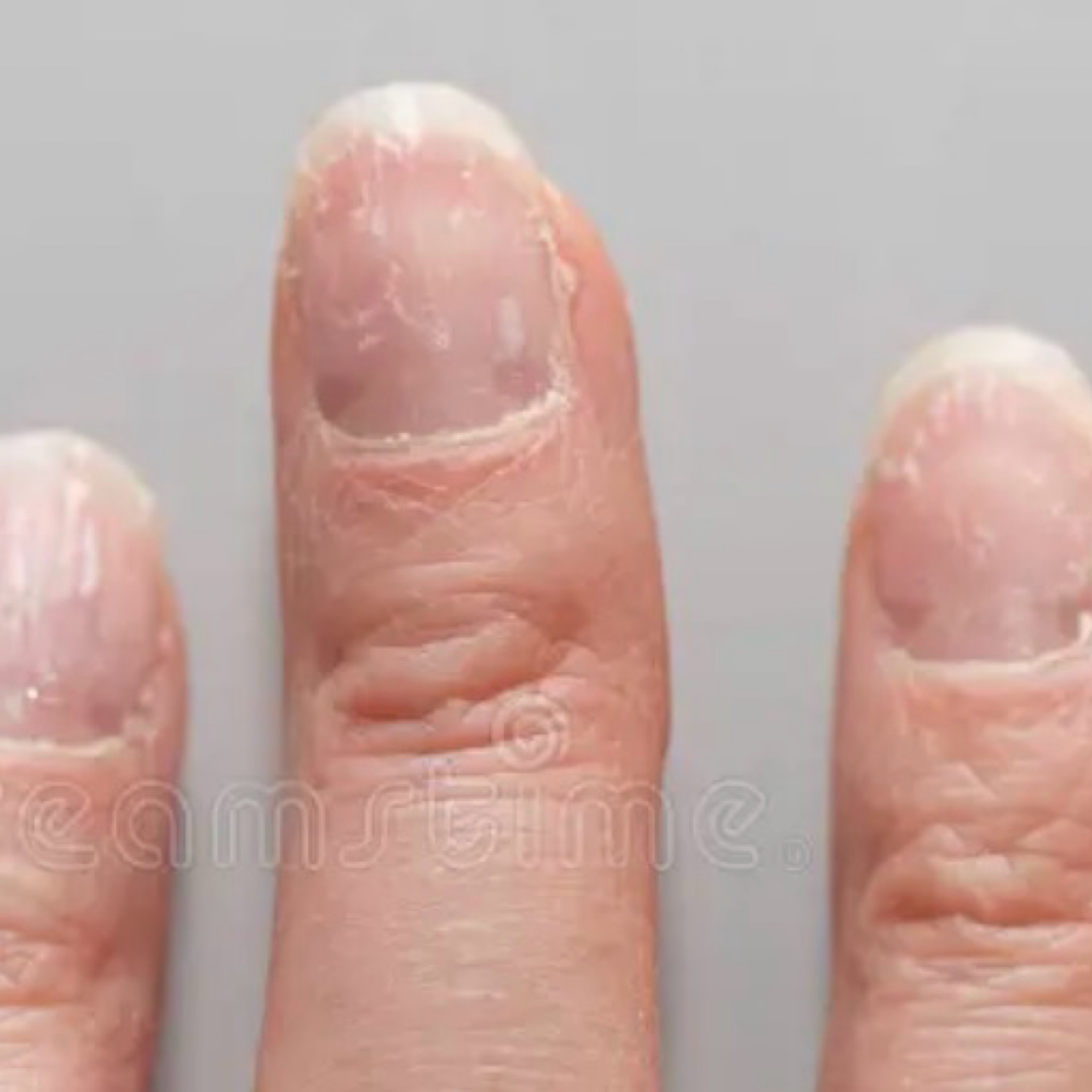 Mais de 2 unhas partidas