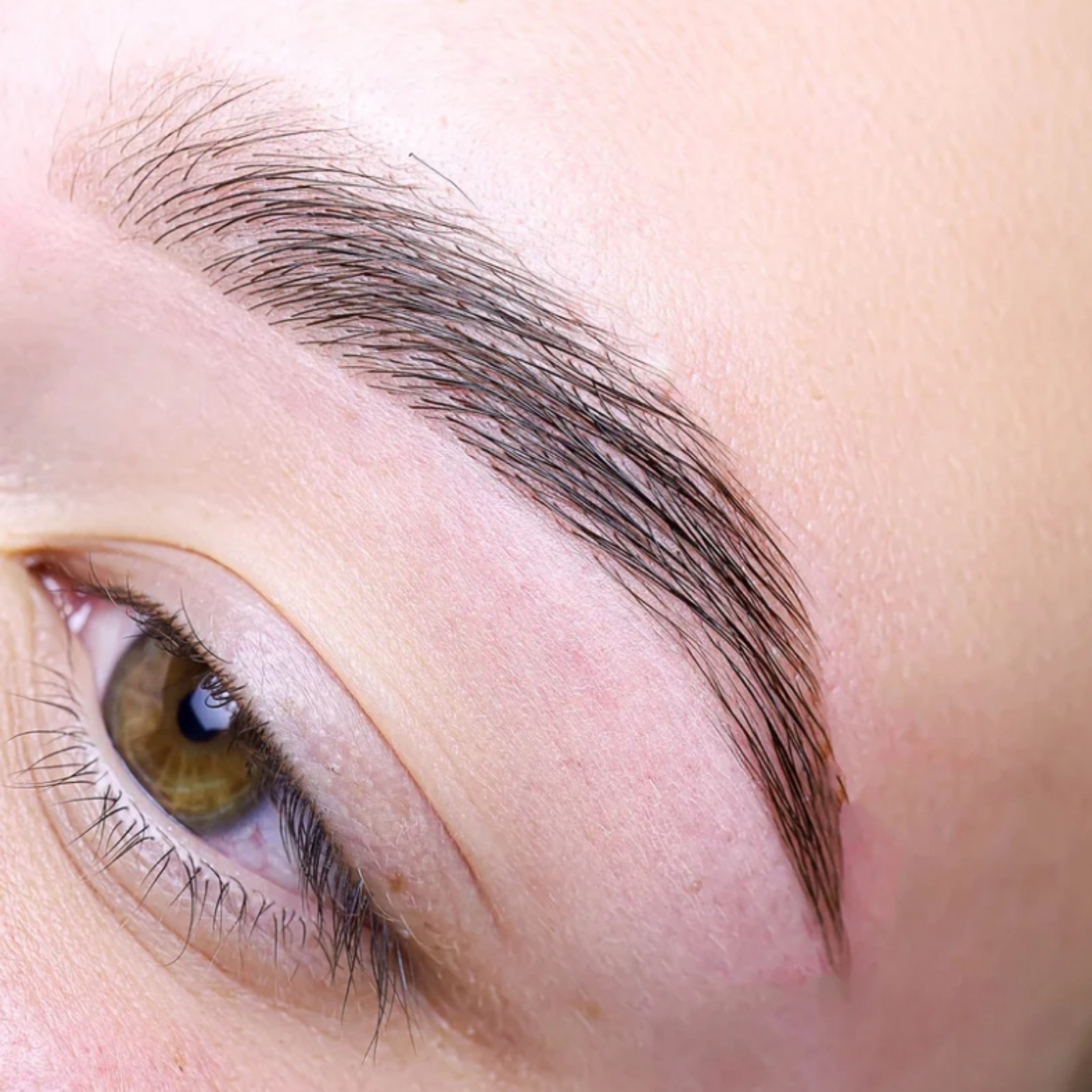 Brow lift
