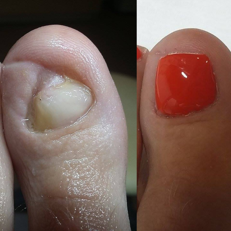 1 Nechtová náhrada (Protetika) 15€