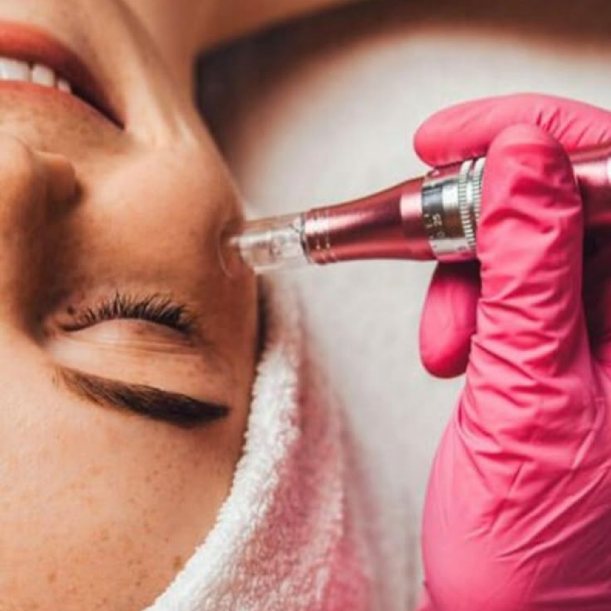 Dermapenes bőrmegújító kezelés
