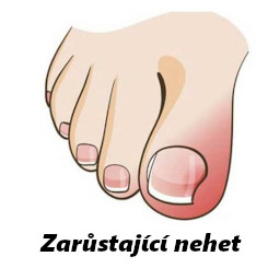 Ošetření zarostlého nehtu samostatně bez pedikúry