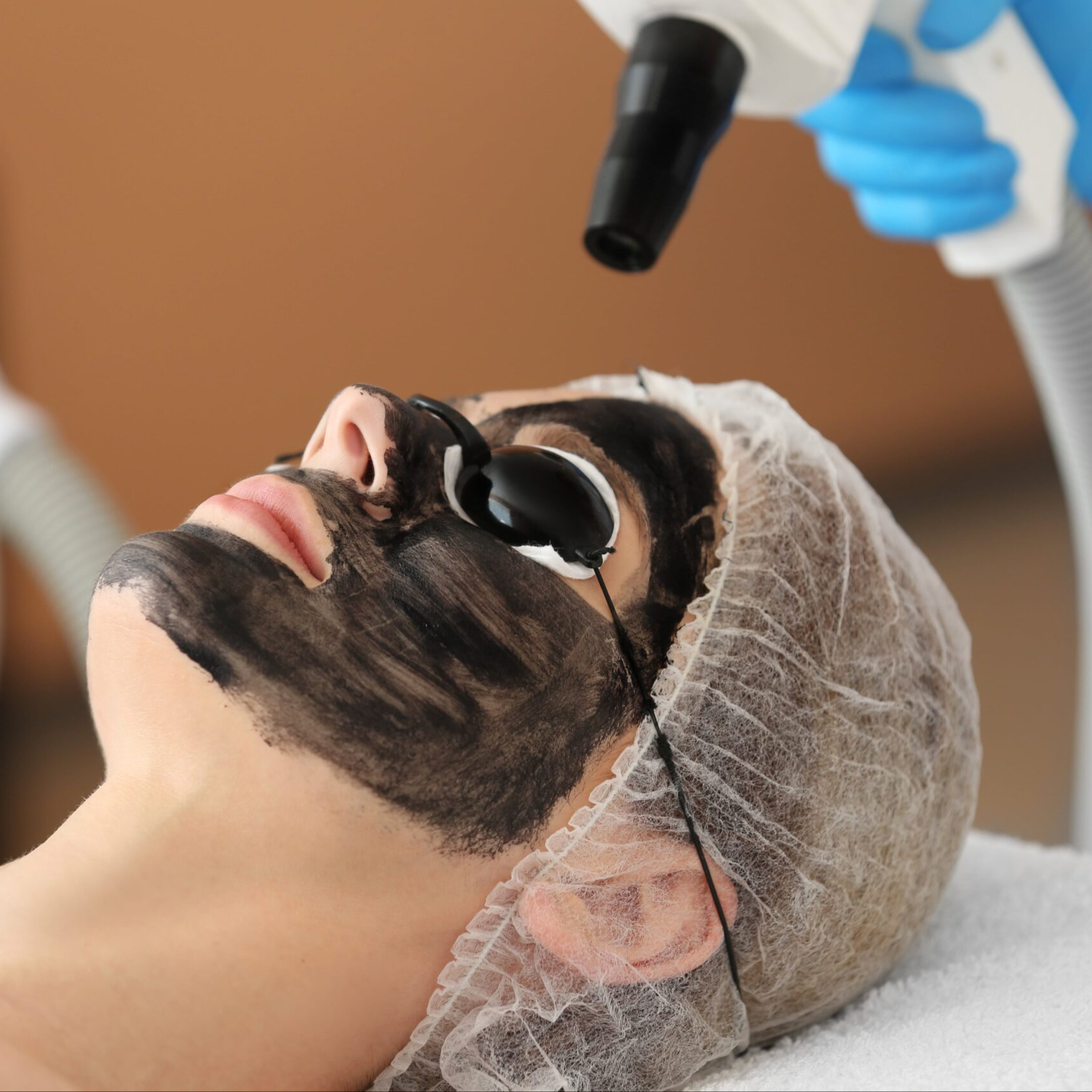 Black Carbon Peel (Hollywood Peel).