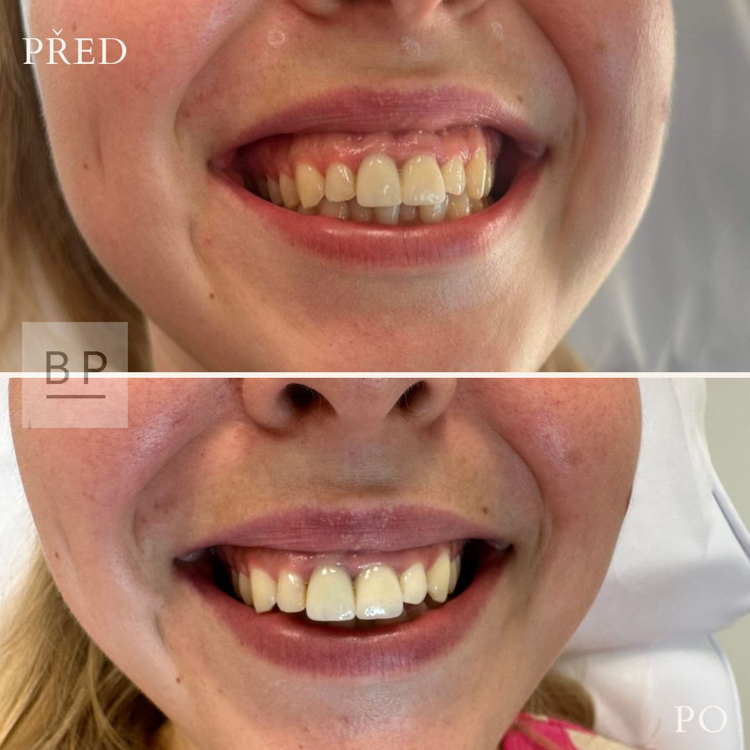 Aplikace botulotoxinu - gummy smile