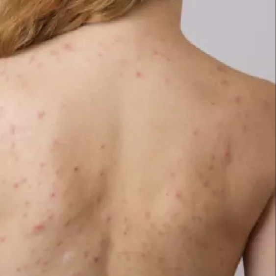 IPL léčba akné, jizvy, červené žilky - záda