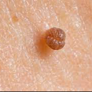 STEELWRATJES VERWIJDEREN