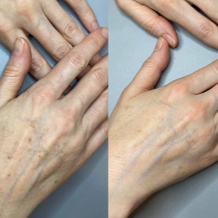 IPL odstranění pigmentace - dlaně