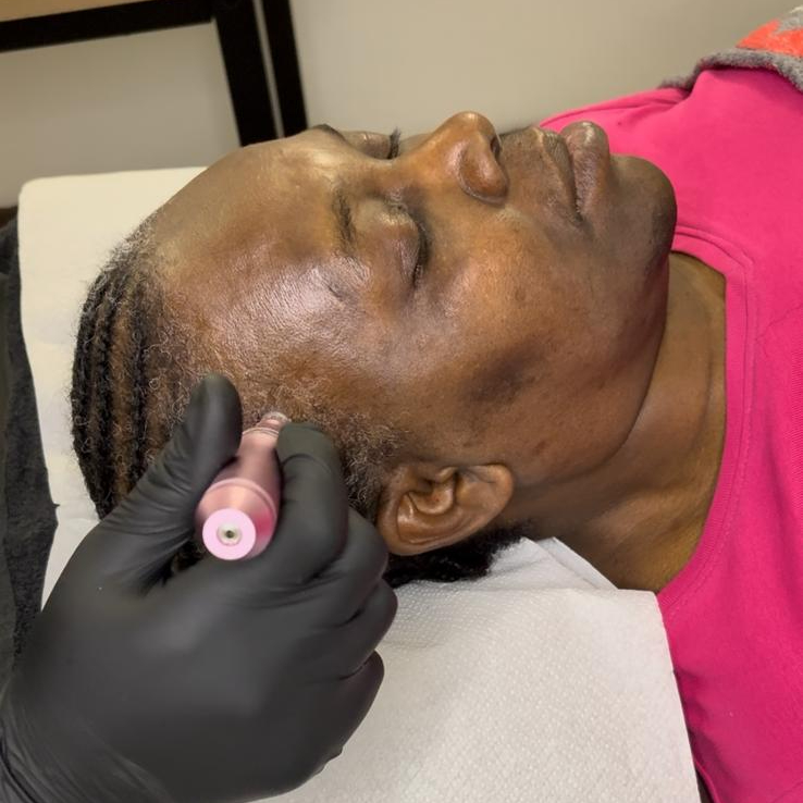 Hairneedling - Tempes ou zones localisées
