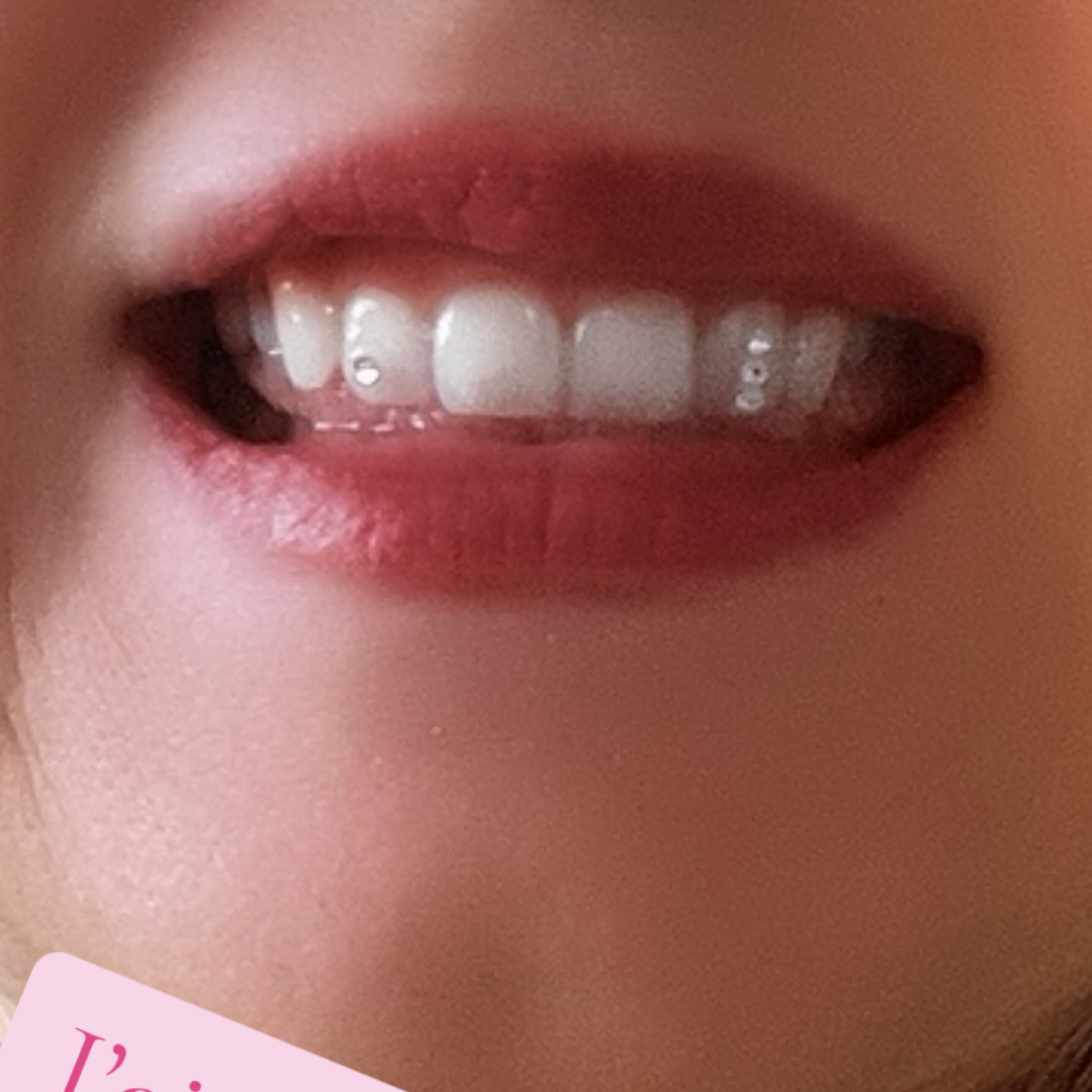 Tooth Gem – L’Accessoire Mode de votre Sourire