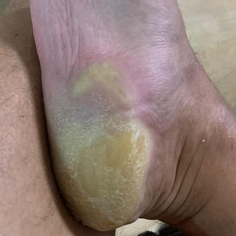 Ošetření otlaků, kuřího oka