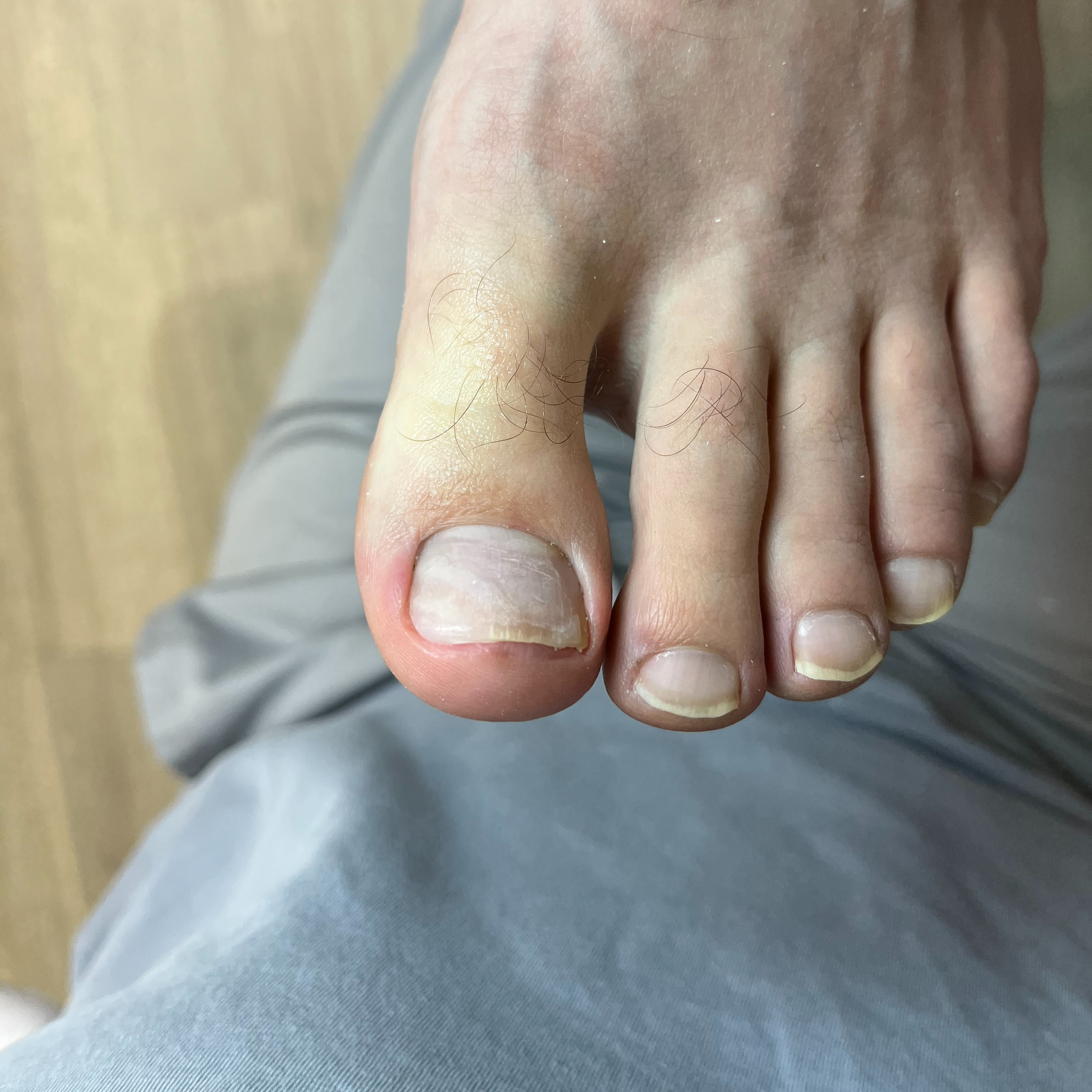 Zhotovení umělého náhradního nehtu