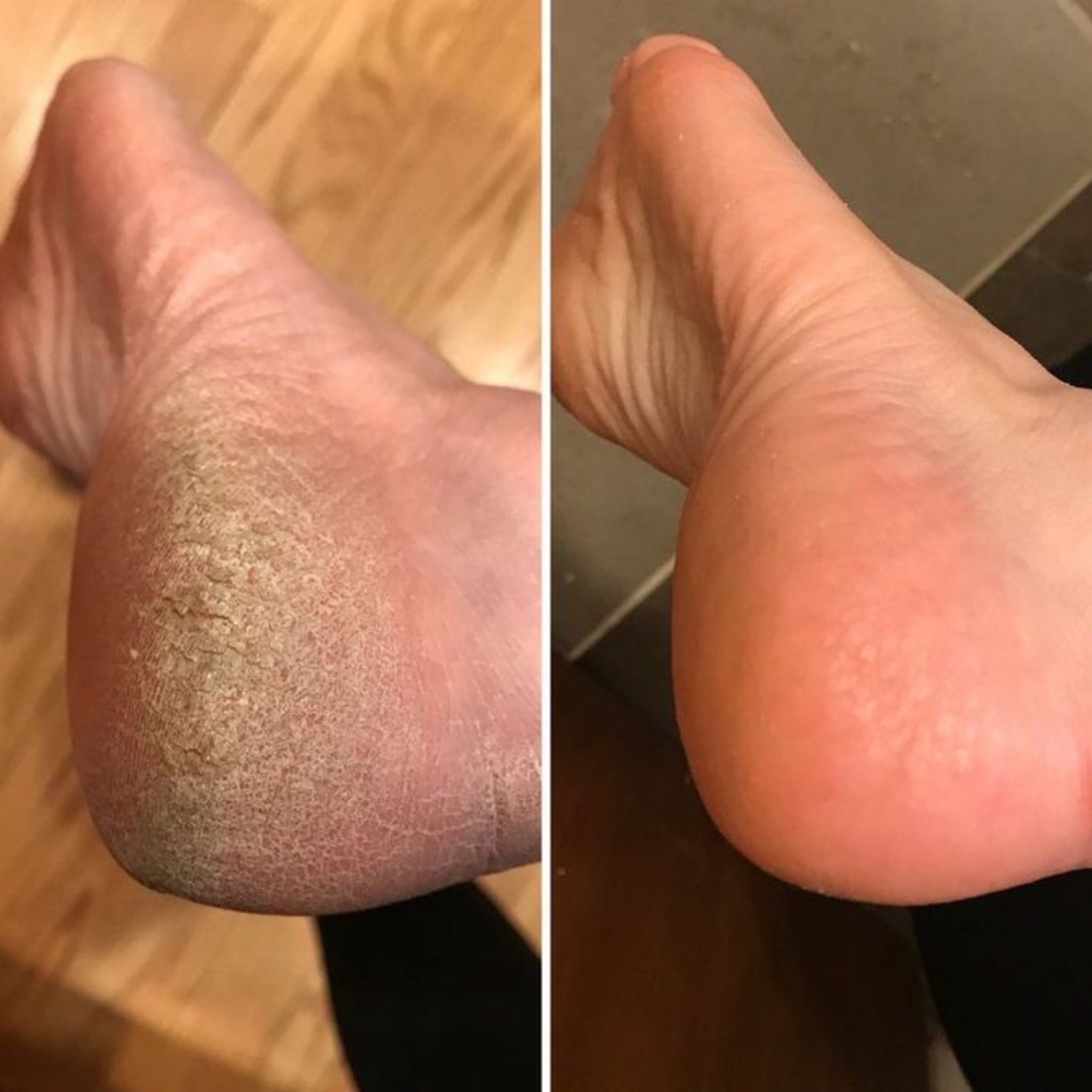 Callus Peeling
