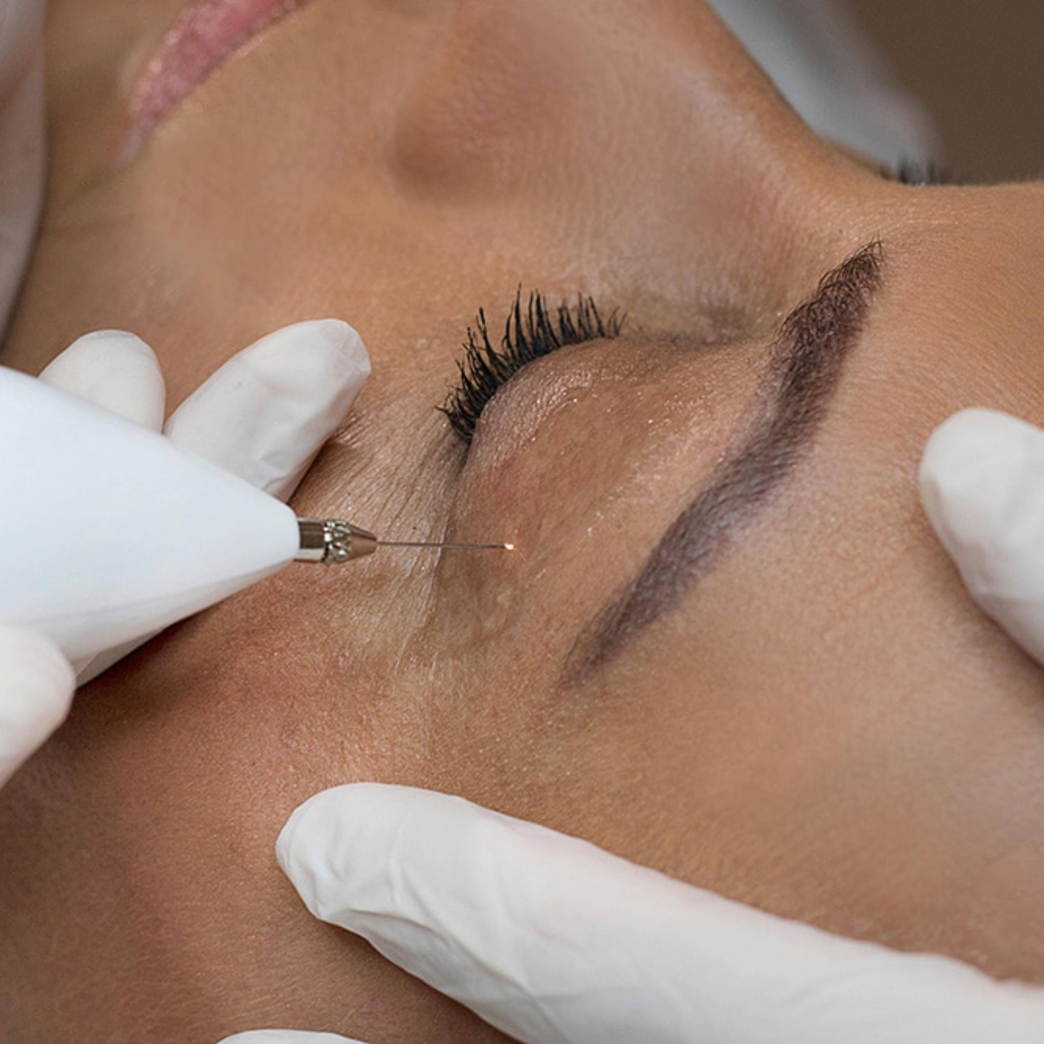 OČNÍ VÍČKA+ čelo+ spánek